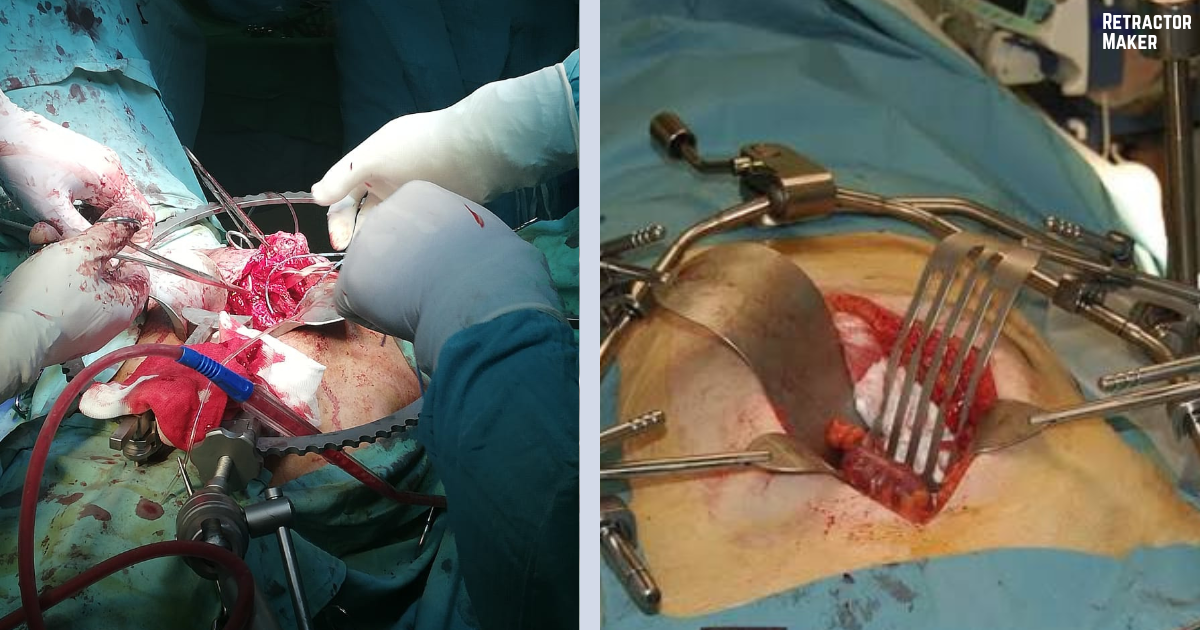 Bookwalter and Omni retractor systems in use during open surgery