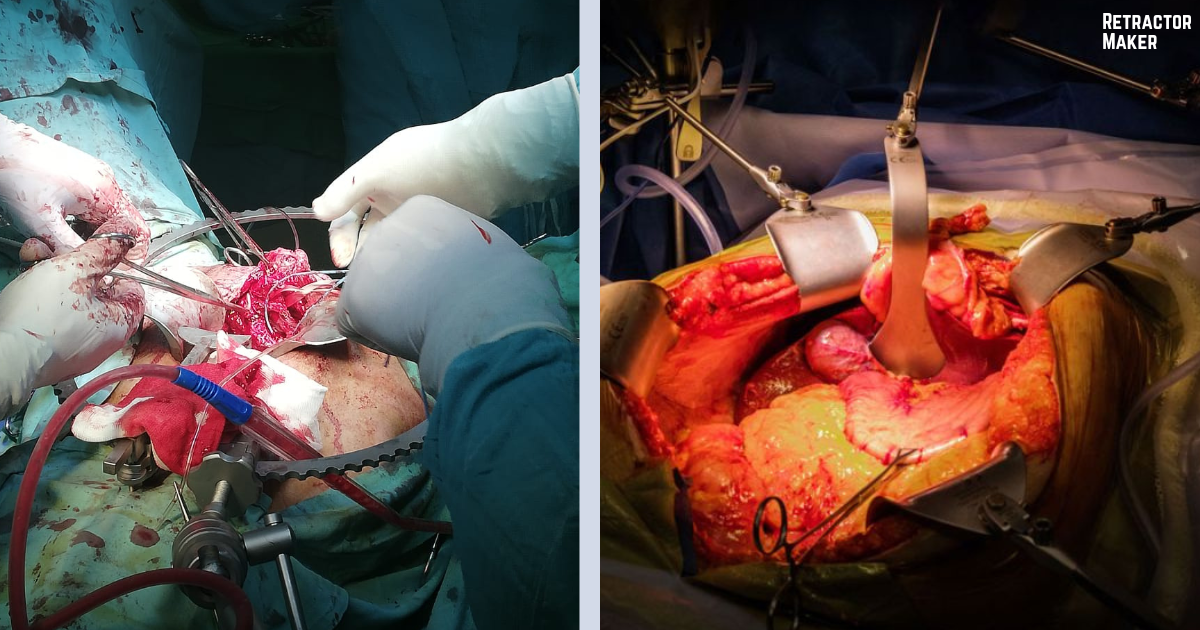 Self-retaining retractor systems in use during surgery