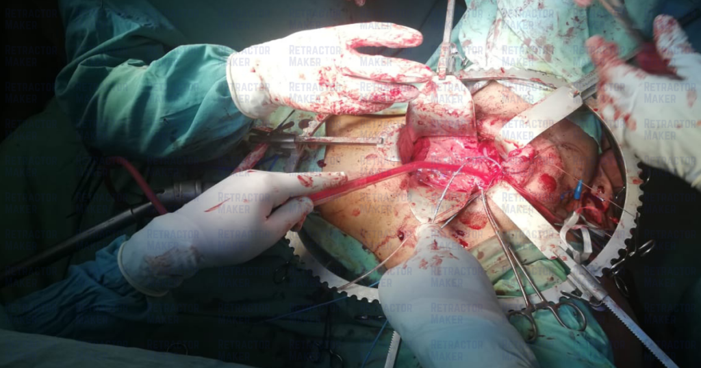 Table-mounted Bookwalter Retractor System maintaining multi-directional tissue exposure during open surgery