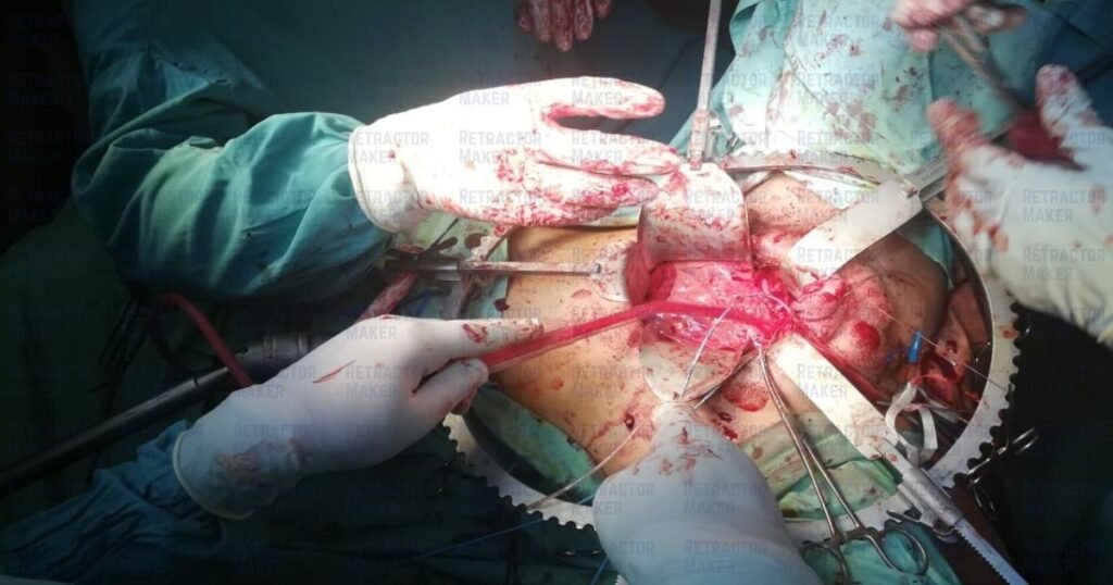 Clear abdominal cavity exposure achieved using a table-mounted Bookwalter Retractor System