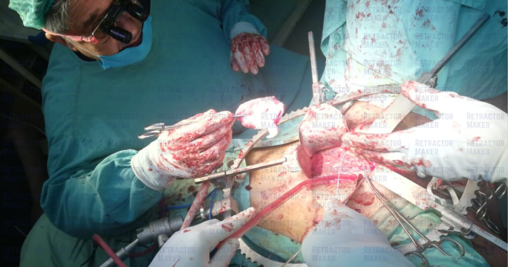 Surgical team performing open abdominal surgery with a Bookwalter Retractor System
